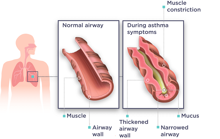 What Are The Asthma Symptoms And How Do I Know If I Have Asthma