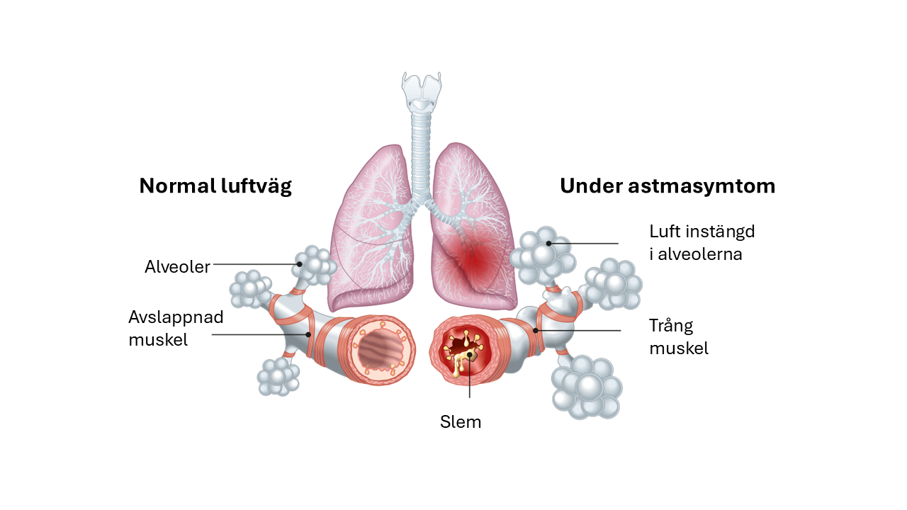 Asthmatic vs normal airways_editable_ny bild.png